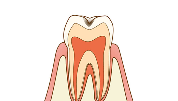 C1：感染歯質が表層のエナメル質に限局した感染症